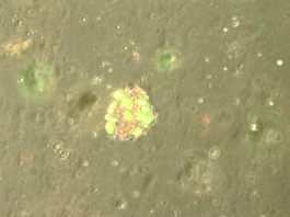 Mini-tumor van dikke darmkankercellen met een kleuring. Groen zijn levende cellen en rood zijn dode cellen.